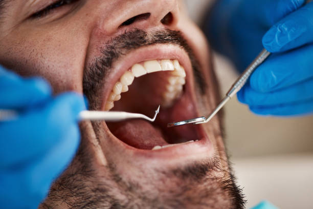 Best Emergency Dental Care for Broken or Chipped Teeth in Princeton, TX